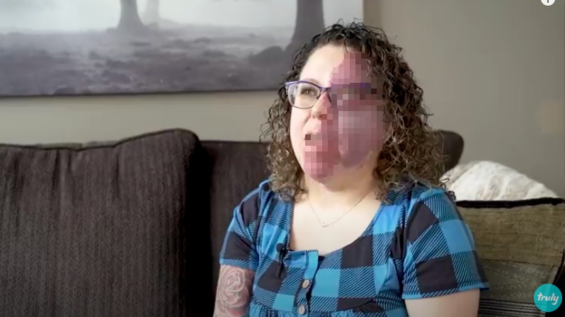 スタージ・ウェーバー症候群はどのように診断されますか?